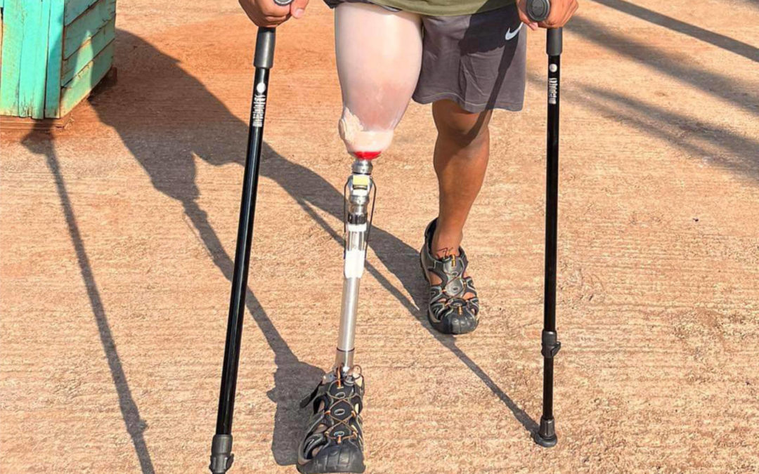 A brand-new prosthesis leg for this young guy